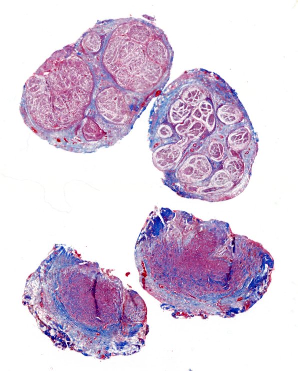 8C1 Neuroma (Case 8) Trichrome WM
