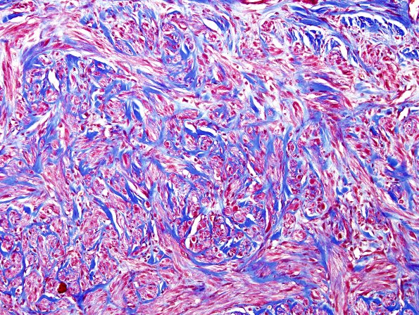 8C2 Neuroma (Case 8) Trichrome 1
