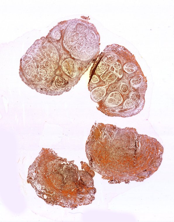 8D1 Neuroma, traumatic (Case 8) Retic WM