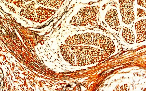 8D2 Neuroma, traumatic (Case 8) Retic 20X