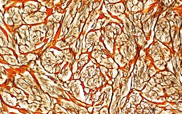 8D3 Neuroma, traumatic (Case 8) Retic 40X 2