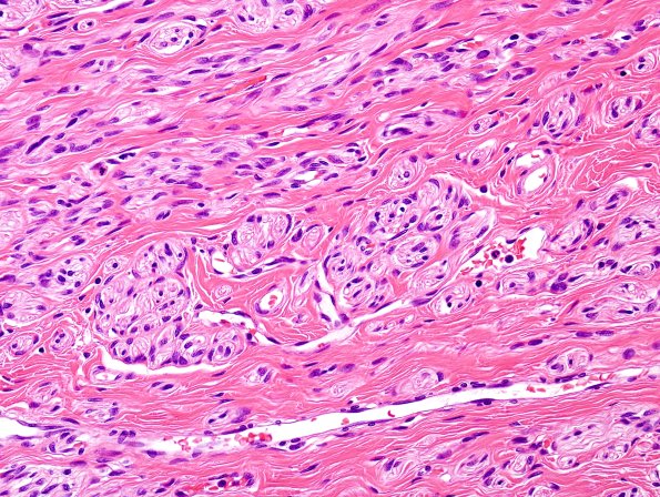 9A Neuroma, traumatic (Case 9) H&E 1