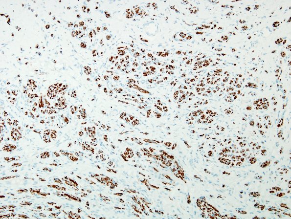 9B1 Neuroma, traumatic (Case 9) NF 2