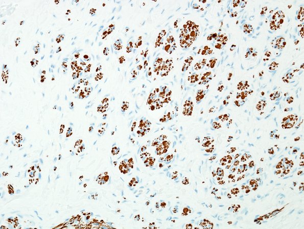 9B2 Neuroma, traumatic (Case 9) NF 1
