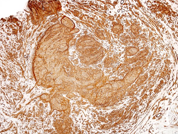 9C1 Neuroma, traumatic (Case 9) Coll IV 4