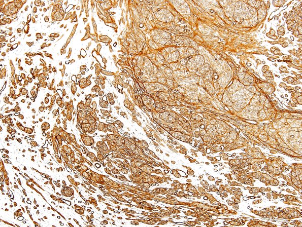 9C2 Neuroma, traumatic (Case 9) Coll IV 3