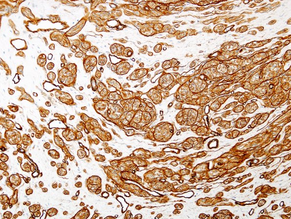 9C3 Neuroma, traumatic (Case 9) Coll IV 2