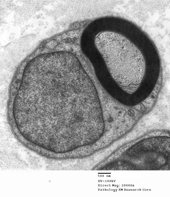 11A1 (Case 11) EM 006 - Copy