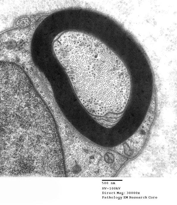 11A2 (Case 11) EM 002 - Copy