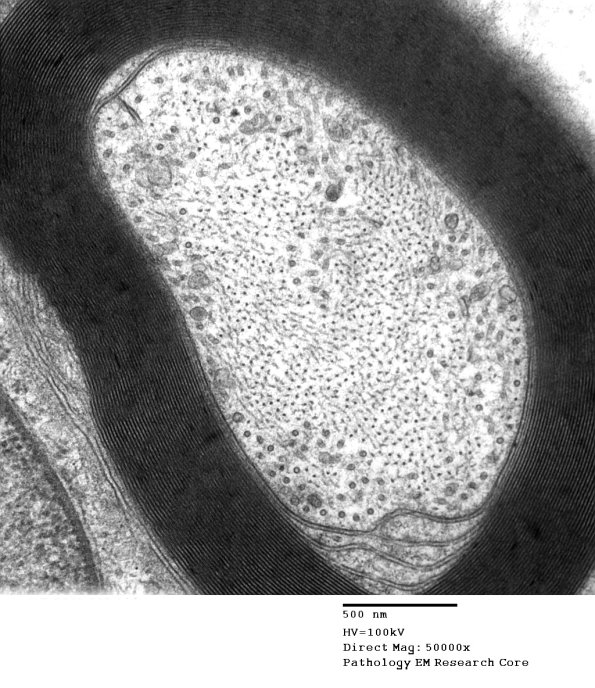 11A3 (Case 11 EM 003 - Copy