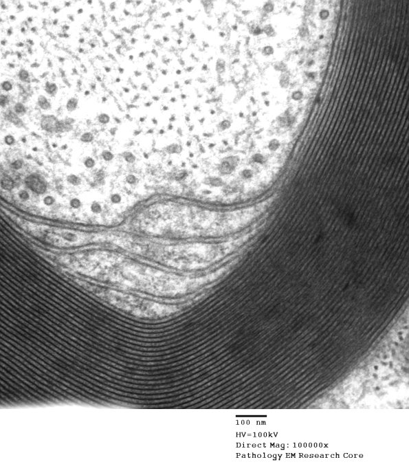 11A4 (Case 11) EM 004 - Copy