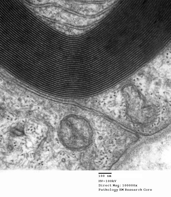 11A5 (Case 11) EM 005 - Copy
