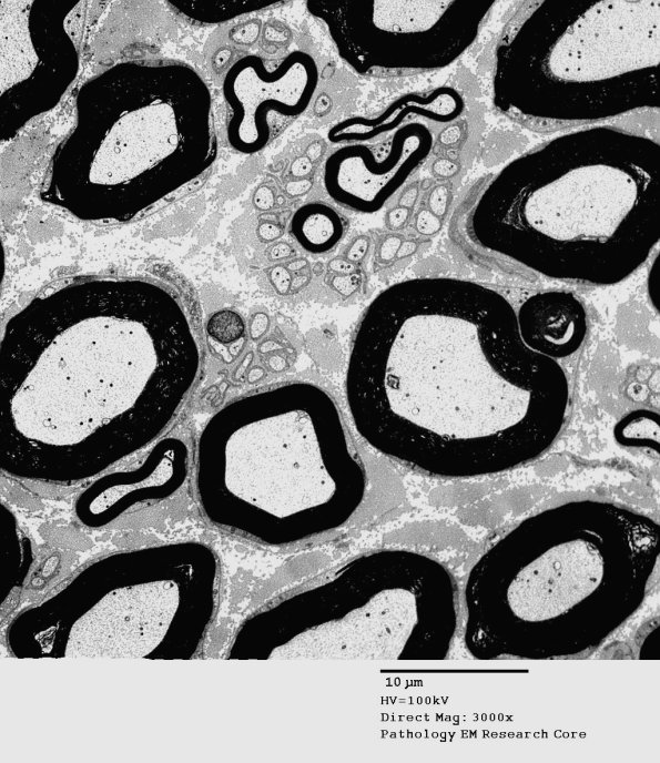 1A1 Normal Nerve (Case 1) new_019A - Copy
