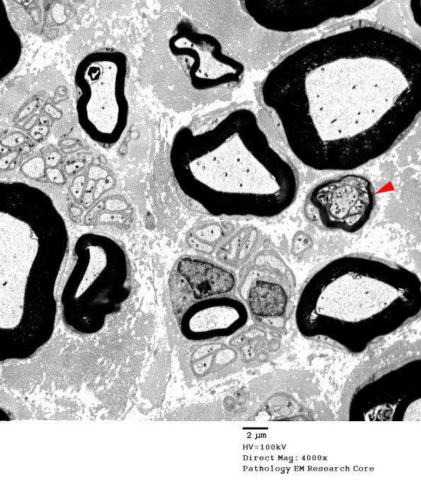 1A2 Normal Nerve (Case 1) new_025A - Copy copy