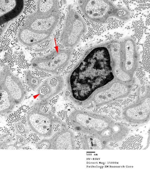 3A Normal axons, sural (Case 3) EM 075 - Copy copy