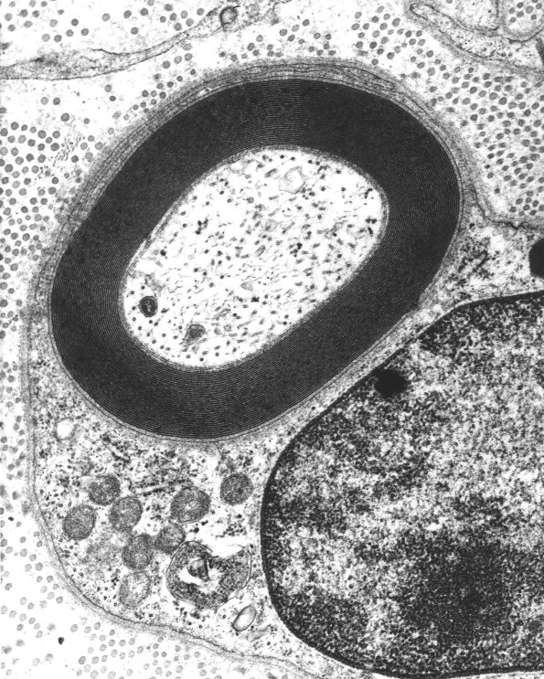 5A1 Axon, normal, PNS EM 1 (2) (Case 5) - Copy
