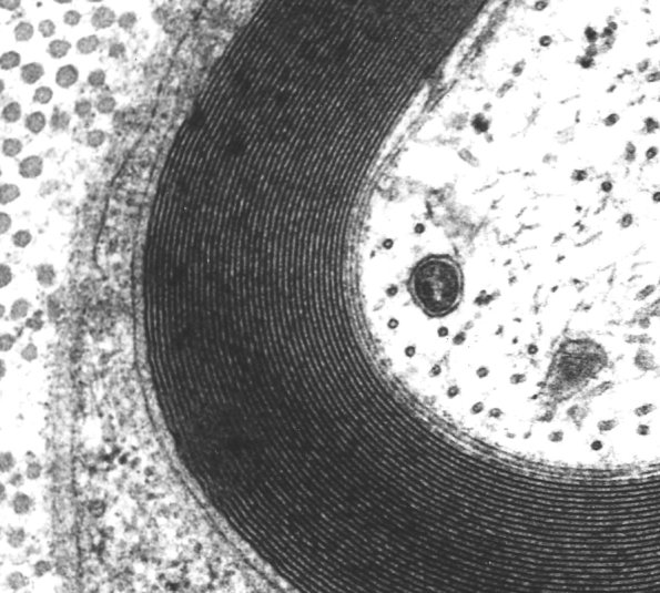 5A2 Axon, normal, PNS EM 3 (Case 5) - Copy