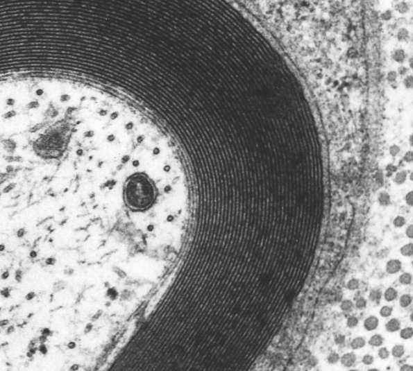 8A2 Axon, normal, PNS EM 3 (Case 8)) - Copy