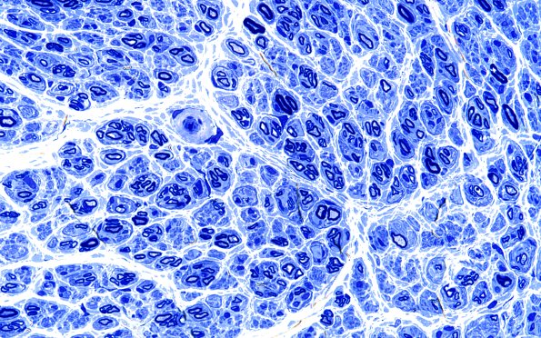 10B3 Pseudo-OB (Case 10) Plastic 60X