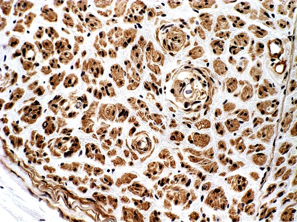 2B4 Pseudo-Onion Bulb (Case 2) Coll IV