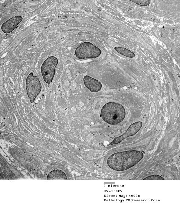 2F14 (Case 2) Nerve_058 - Copy