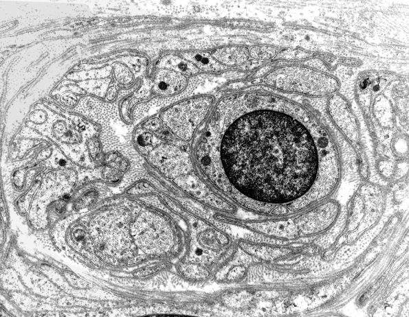 2F5B PseudoOB (Case 2) EM 2a - Copy