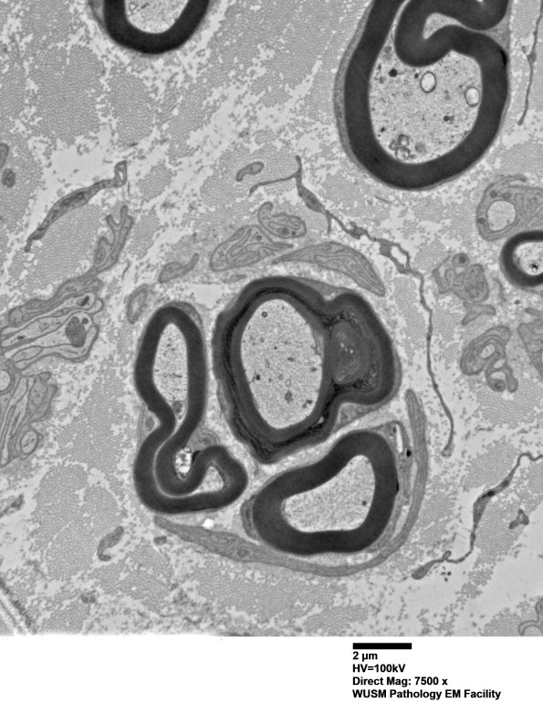 6C2 (Case 6) EM044 - Copy