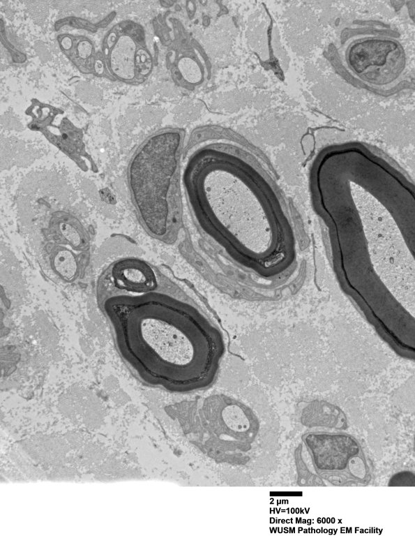 6C5 (Case 6) EM013 - Copy