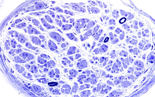 8B1 (Case 8) Nerve Plastic 60X 1