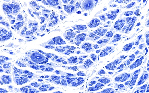 8B2 (Case 8) Nerve Plastic 100X 1