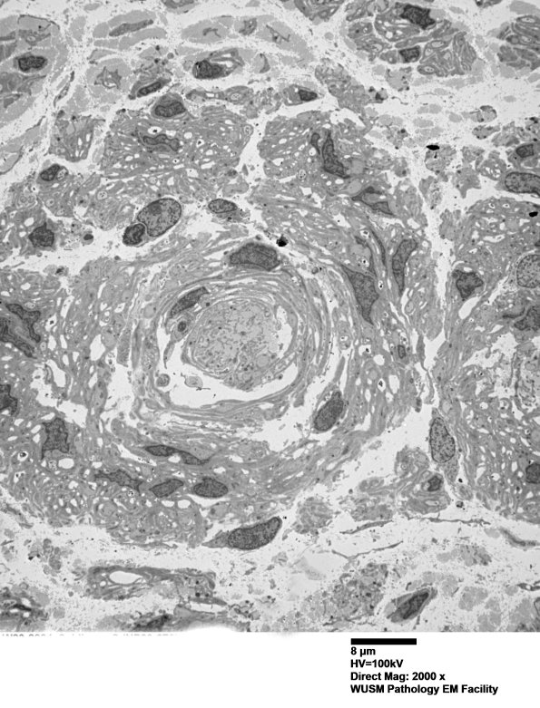 8C1A (Case 8) Nerve_010 - Copy