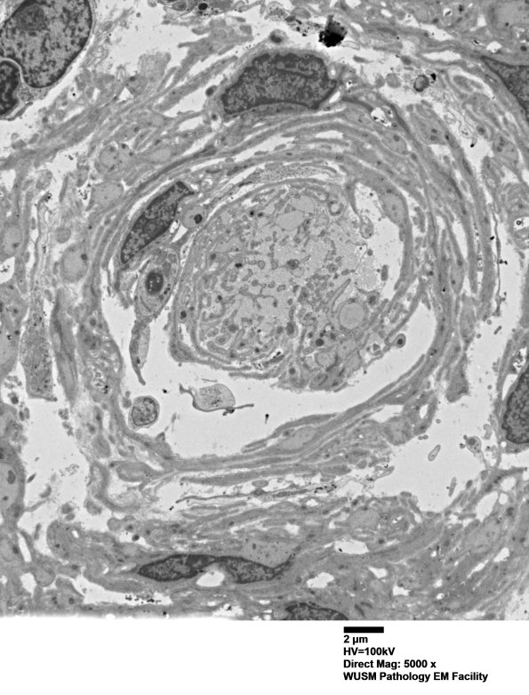 8C1B (Case 8) Nerve_013 - Copy