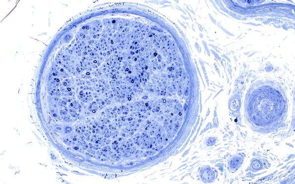 9A1 PseudoOB (Case 9) Plastic 20X 2