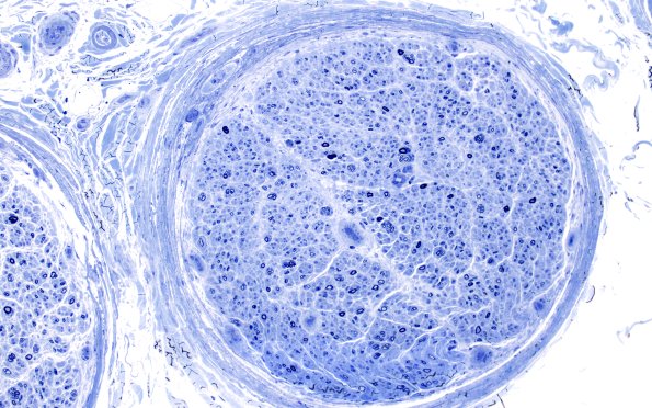 9A2 PseudoOB (Case 9) Plastic 20X