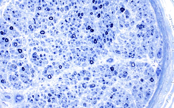 9A3 PseudoOB (Case 9) Plastic 40X