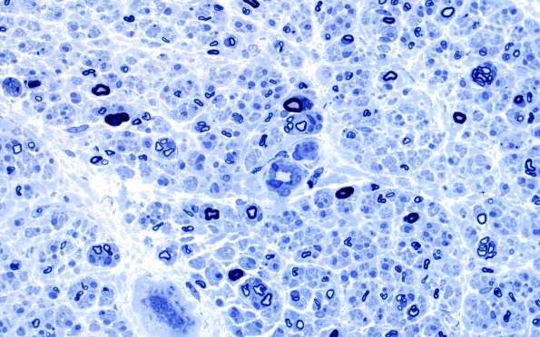 9A4 PseudoOB (Case 9) Plastic 60X 2