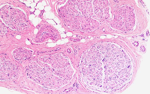 1A1 Primary Biliary Cirrhosis (Case 1) H&E 4X 2
