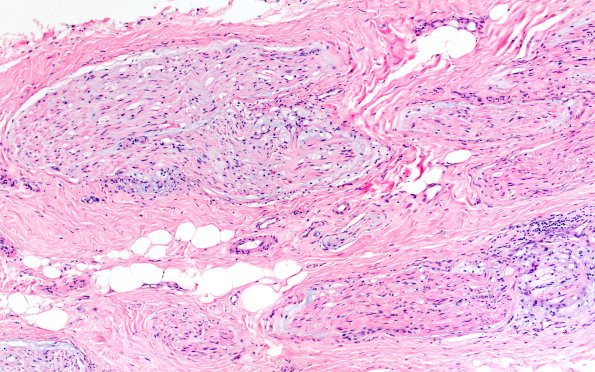 1A2 Primary Biliary Cirrhosis (Case 1) H&E 10X 1