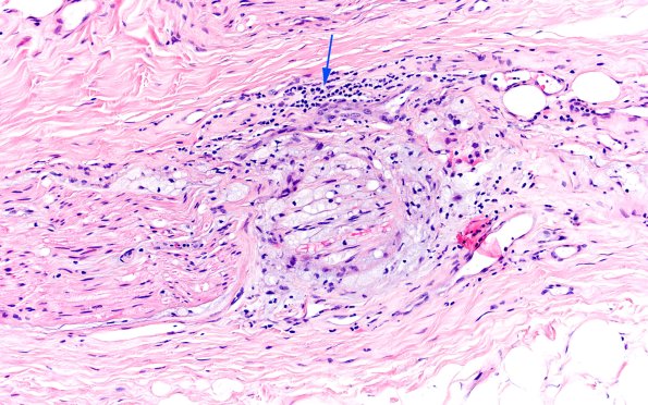 1A4 Primary Biliary Cirrhosis (Case 1) H&E 20X 2 copy