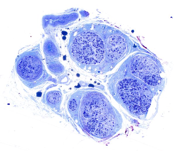1B1 Primary Biliary Cirrhosis (Case 1) Best Plastic 4X 1