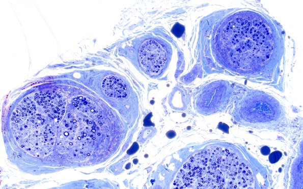 1B2 Primary Biliary Cirrhosis (Case 1) Best Plastic 10X 1