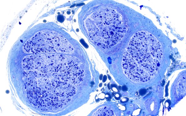 1B3 Primary Biliary Cirrhosis (Case 1) Plastic 10X 1