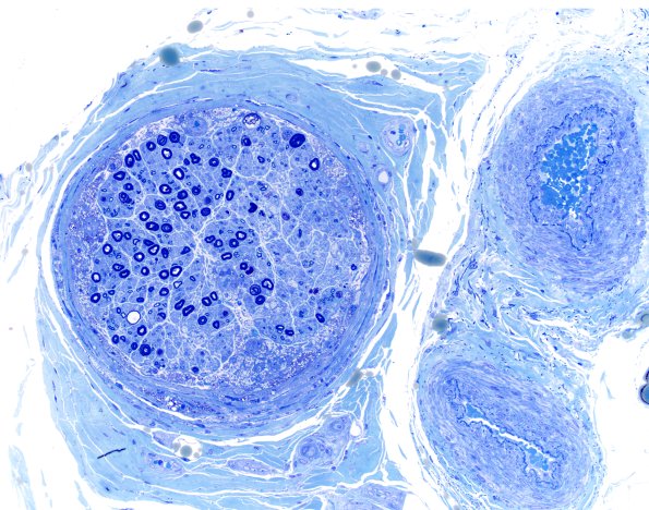1B4A Primary Biliary Cirrhosis (Case 1) Best Plastic 20X 4