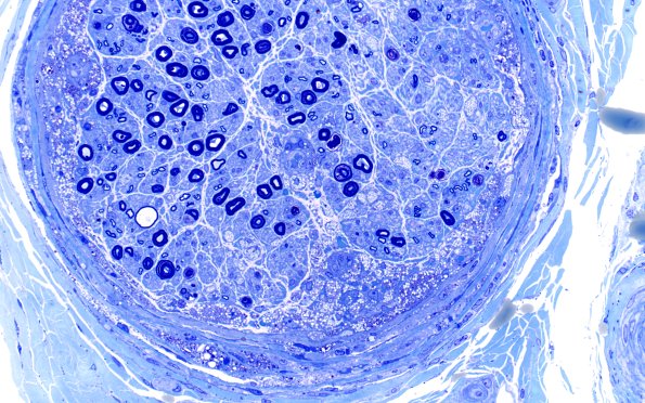 1B4C Primary Biliary Cirrhosis (Case 1) Best Plastic 40X 5