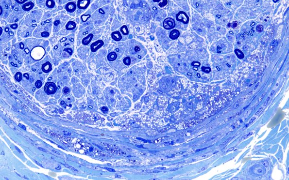 1B4D Primary Biliary Cirrhosis (Case 1) Best Plastic 60X 3
