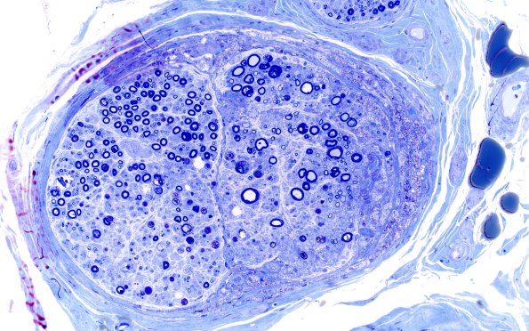 1B5A Primary Biliary Cirrhosis (Case 1) Best Plastic 20X 3