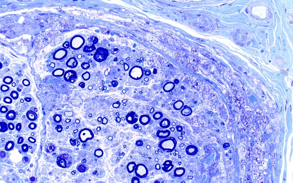 1B5B Primary Biliary Cirrhosis (Case 1) Best Plastic 40X 1