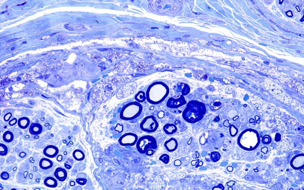 1B5D Primary Biliary Cirrhosis (Case 1) Best Plastic 60X 2