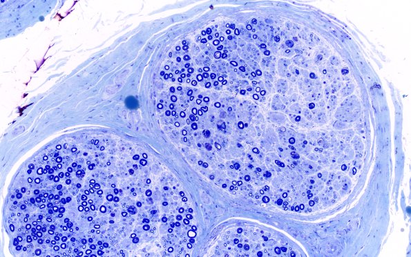 1B6 Primary Biliary Cirrhosis (Case 1) Plastic 20X 2