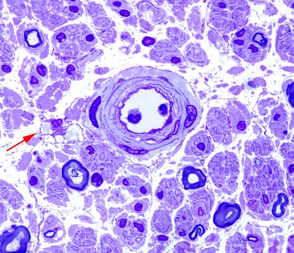 1A1 Vitamin E Def (Case 1) Plastic 100X 2 copy.jpg